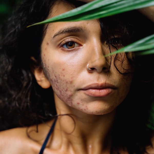 Photo of a woman with acne